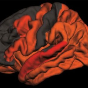 Sleep Patterns Offer Clues to Alzheimer’s and How to Fight It.